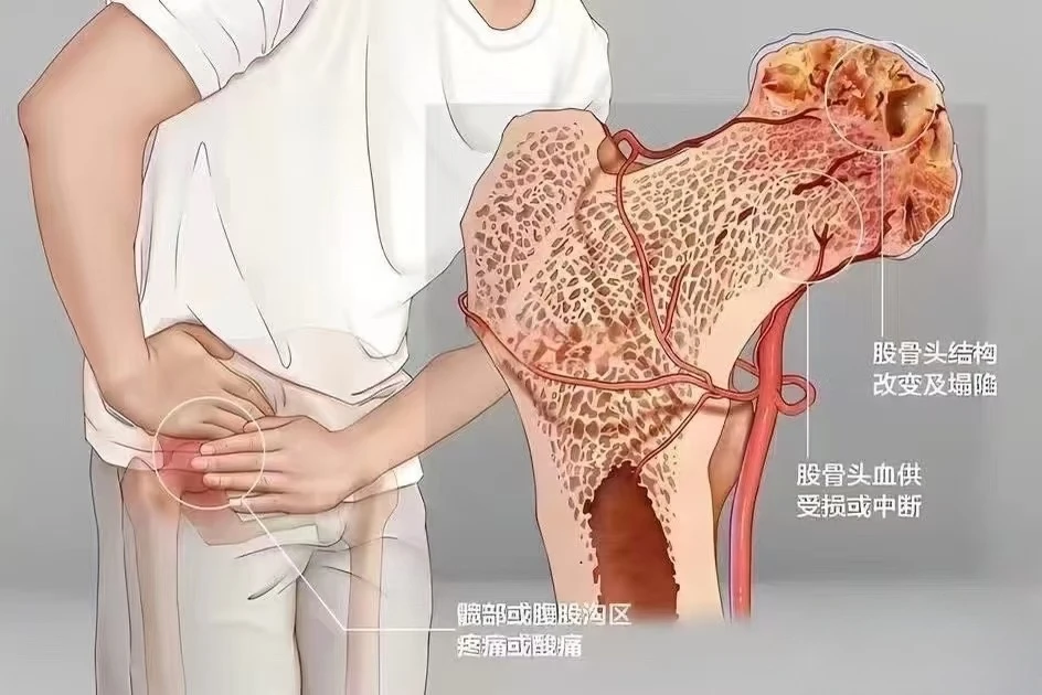 髋部反复疼痛？别忽视！股骨头坏死有三期预警，五类人应尽早筛查